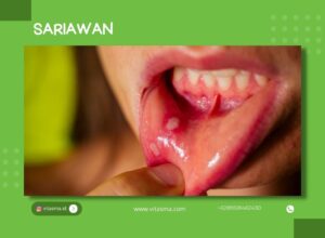 sariawan