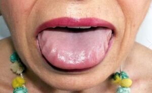 Amyloidosis