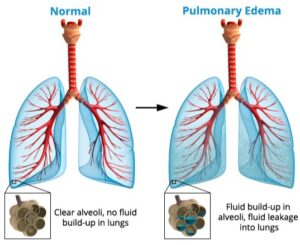 Edema Paru