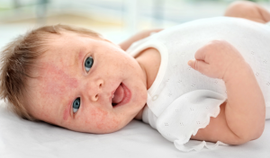 Biang Keringat pada Si Kecil