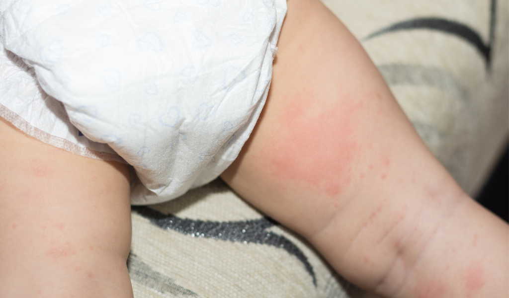 Biang Keringat pada Si Kecil